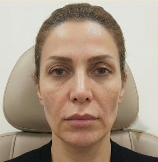 علاجات تجميلية غير جراحية before treatment result at IranElaj
